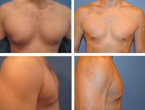 How To Get Insurance To Pay For Gynecomastia Surgery