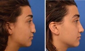 How much does a Nose Job Cost with Insurance
